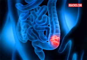 EsSalud alerta incremento de cáncer de colon en adolescentes y jóvenes EsSalud alerta incremento de cáncer de colon en adolescentes y jóvenes