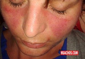 Mujeres entre 20 y 40 años de edad pueden padecer el incurable y silencioso Lupus Mujeres entre 20 y 40 años de edad pueden padecer el incurable y silencioso Lupus