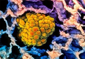 Cinco verdades sobre la 'mala suerte' de tener cáncer Cinco verdades sobre la 'mala suerte' de tener cáncer